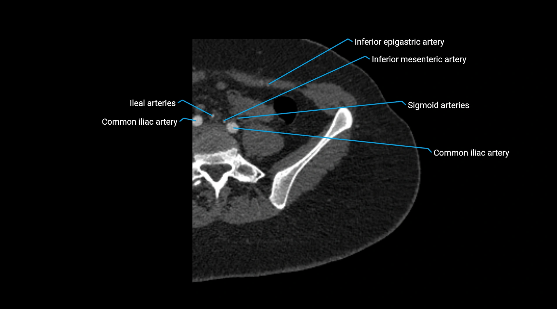 CTA lower limb cross sectional anatomy labelled image _11.webp